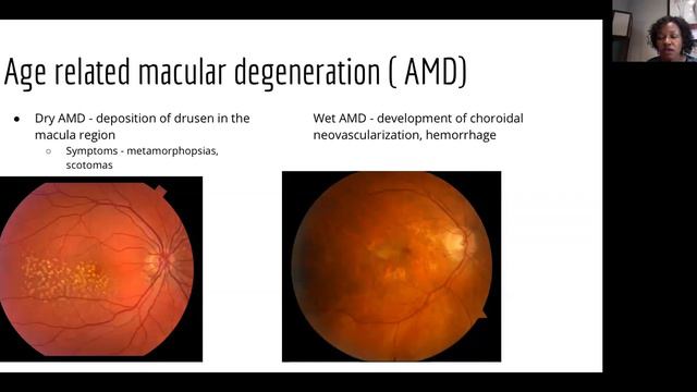 Mogeni & Gichoya Notes - Session 6: Ophthalmology Review with Dr. Mathenge смотреть онлайн