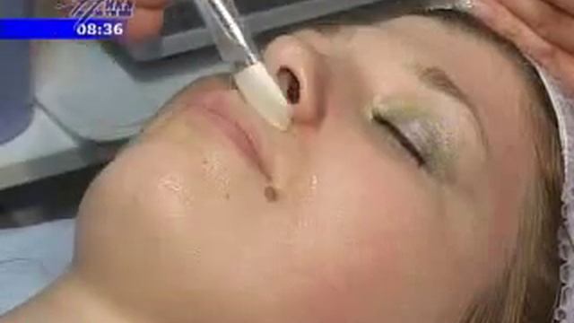 химический пилинг смотреть онлайн