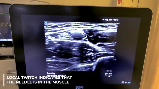 Axillary Block Decision Making Explained - Crash Course With Dr. Hadzic