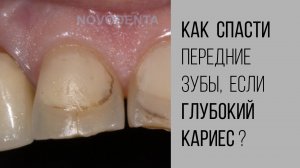 Как лечится кариес передних зубов❓