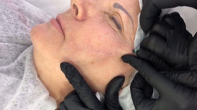 Нитевые методики смотреть онлайн