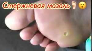 Стержневая мозоль??