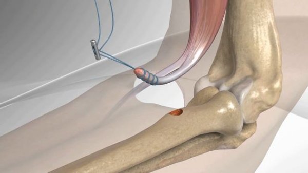 Distal Biceps Repair with Arthrex® Tension Slide