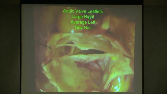NCMA Spring 2014 Advances in Cardiovascular Surgery with Dr Joseph Woo смотреть онлайн