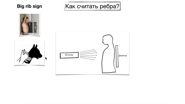 Как считать ребра на рентгенограмме? БОКОВАЯ ПРОЕКЦИЯ | Рентгенология