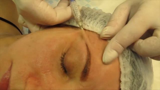 14. Объемное моделирование лица RADIESSE смотреть онлайн