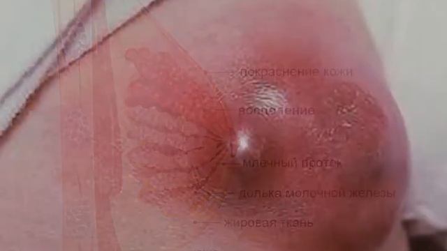 Мастит смотреть онлайн