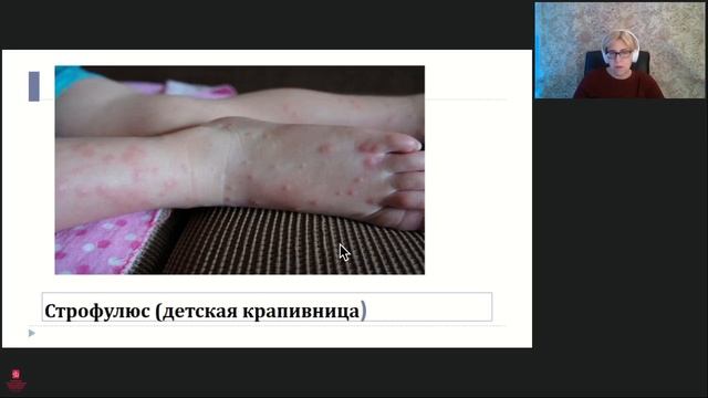 Ветряная оспа у детей Семинар смотреть онлайн