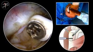 Тенодез длинной головки бицепса анкерным винтом