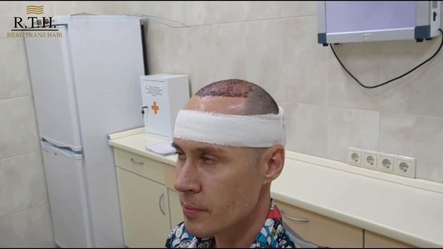 Пересадка волос в Москве в клинике Real Trans Hair. 2200 графтов смотреть онлайн