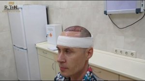 Пересадка волос в Москве в клинике Real Trans Hair. 2200 графтов