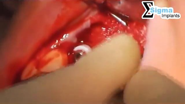 Open sinus lift. Bone grafting. Sigma Implants implantation смотреть онлайн