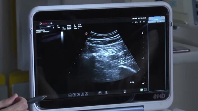 Proximal (Subgluteal & Parasacral) Sciatic Sonography смотреть онлайн