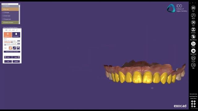 Exocad Smile Creator + iTero Element 5D Plus. In-house Smile Design and Functional Try-In смотреть онлайн