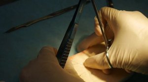 Внутрикожный шов по Холстеду (косметический шов)