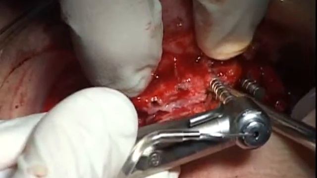 Extraction & Implantation With Alpha-Bio's Implants | ALPHA-BIO TEC.