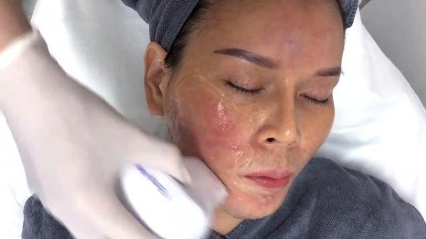 Endymed 3Deep™ RF Anti-aging