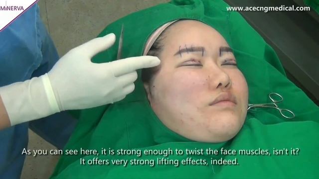 MINERVA Molding Cog Face Lifting -1-