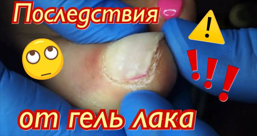 Последствия от гель лака⚠️❗️???? смотреть онлайн