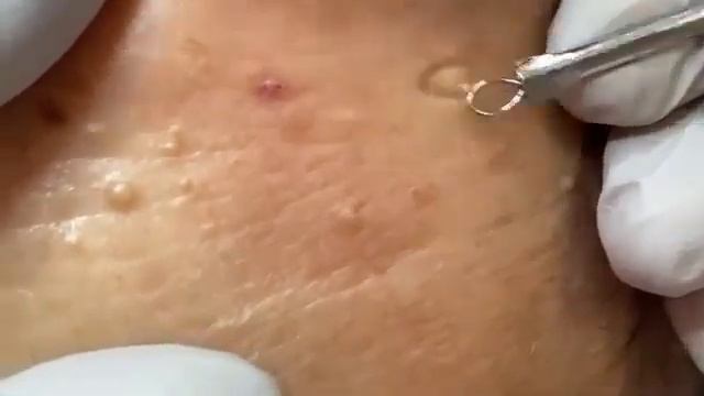 Removes Acne - Давим прыщи, чёрные точки. Залипательно 2021