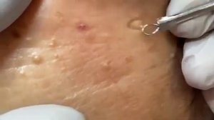 Removes acne - Давим прыщи, чёрные точки. Залипательно 2021