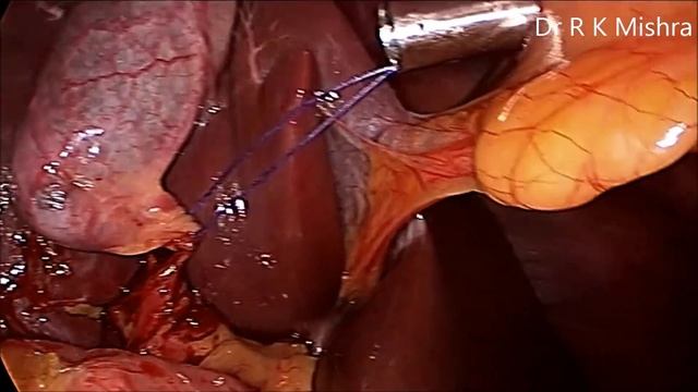 Gallbladder Stone Surgery смотреть онлайн