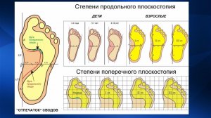 2.12. Массаж при плоскостопии, косолапости, деформациях | Медицинский массаж. Цикл 2