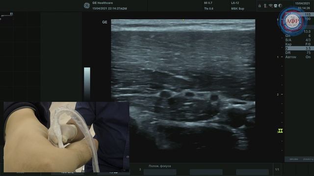 Лучевой нерв от спиральной борозды до плечевого сплетения.