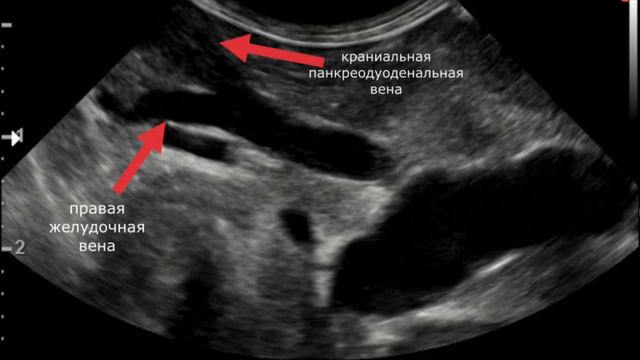 Ультразвуковое исследование портальной вены и основных ветвей смотреть онлайн