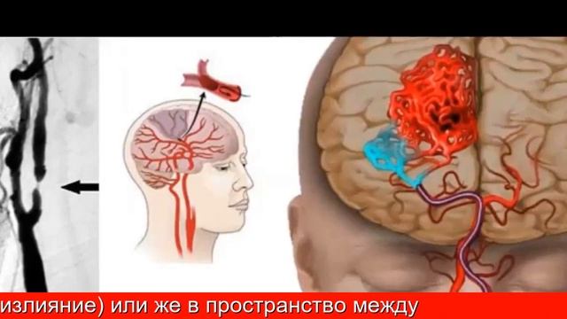 Что чувствует человек во время кровоизлияния в мозг? смотреть онлайн