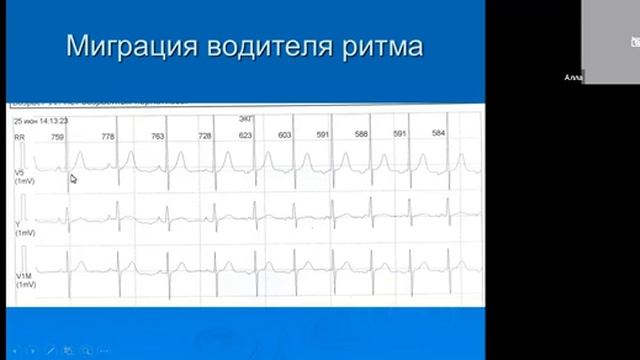 17 02 22 Куприянова АВ Синдром слабости синусового узла смотреть онлайн