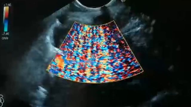 FNB of Mediastinal Lymphadenopathy смотреть онлайн