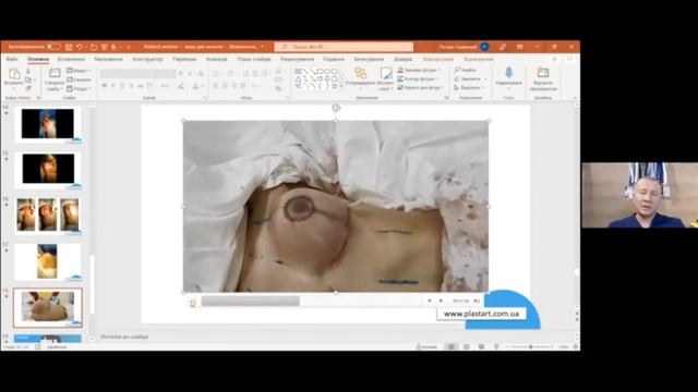 Подтяжка груди на имплантах. Круглые или анатомические? смотреть онлайн