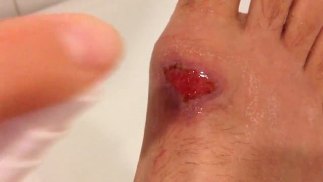 НЕВЕРОЯТОЕ ИСЦЕЛЕНИЕ ОТКРЫТОЙ РАНЫ!