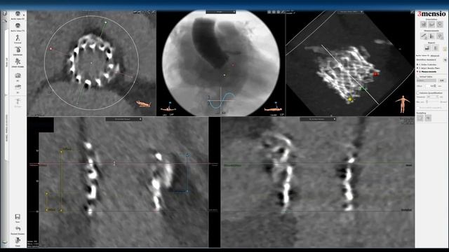 3Mensio CT Pre-case Planning: Redo-TAVR with Prior Sapien 3 (1 of 2) смотреть онлайн