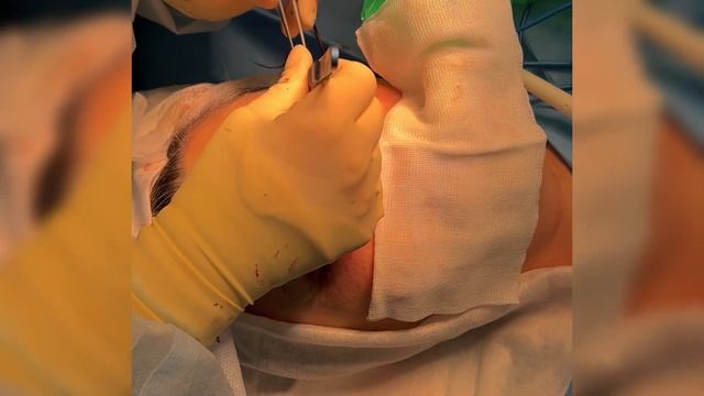 Щипковая или pinch блефаропластика. Грыжи можно не удалять?! смотреть онлайн