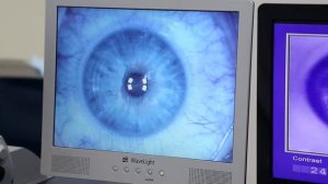 ФемтоЛАСИК Femtolasik — новейшая методика лазерной коррекции в ЦЛКЗиМ Саратов