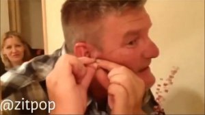 Чистка лица. Прыщи, угри и чёрные точки. Face cleaning. Pimples, blackheads, and black dots.