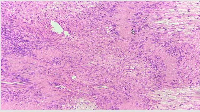 Қатерсіз нейролеммома /шваномма, невролеммома, нейринома және т.б./ смотреть онлайн