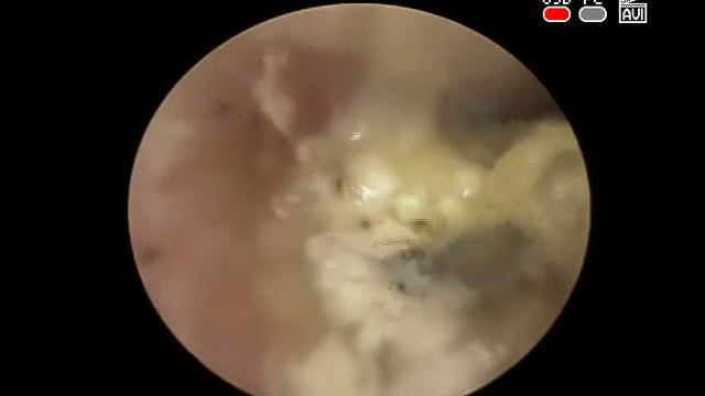 ДИАГНОСТИКА ЛЕЧЕНИЕ #ГРИБКОВОГО #ОТИТА #ОТОМИКОЗ смотреть онлайн