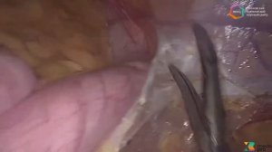 Лапароскопическая резекция сигмовидной кишки, D-2 лимфаденэктомия