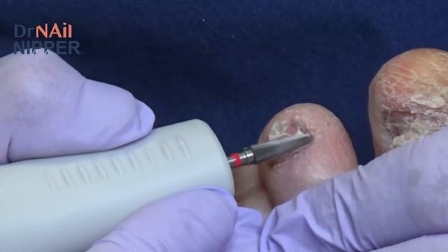 Why Thick Toenails? - Dr Nail Nipper (2021) смотреть онлайн