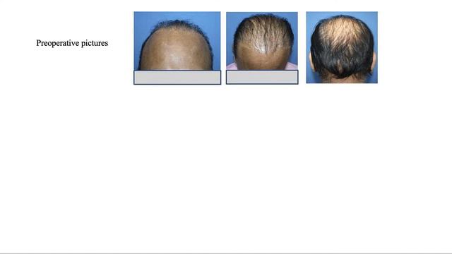 Combination Grafting of Scalp And Body Hair | Chapter 31 | Practical Guide To Hair Transplantation смотреть онлайн