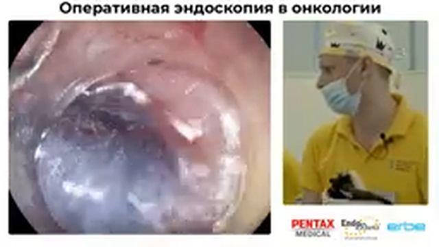 Прямая трансляция из НМИЦ онкологии имени Н.Н. Петрова. Диссекция в подслизистом слое смотреть онлайн