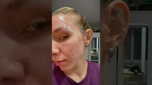 4-й день после ожога бровей #влог #обзор