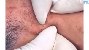 Pimple In The Leg? Best Pimple Popping Compilations #2