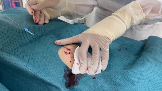 Антеградный бедренный доступ смотреть онлайн