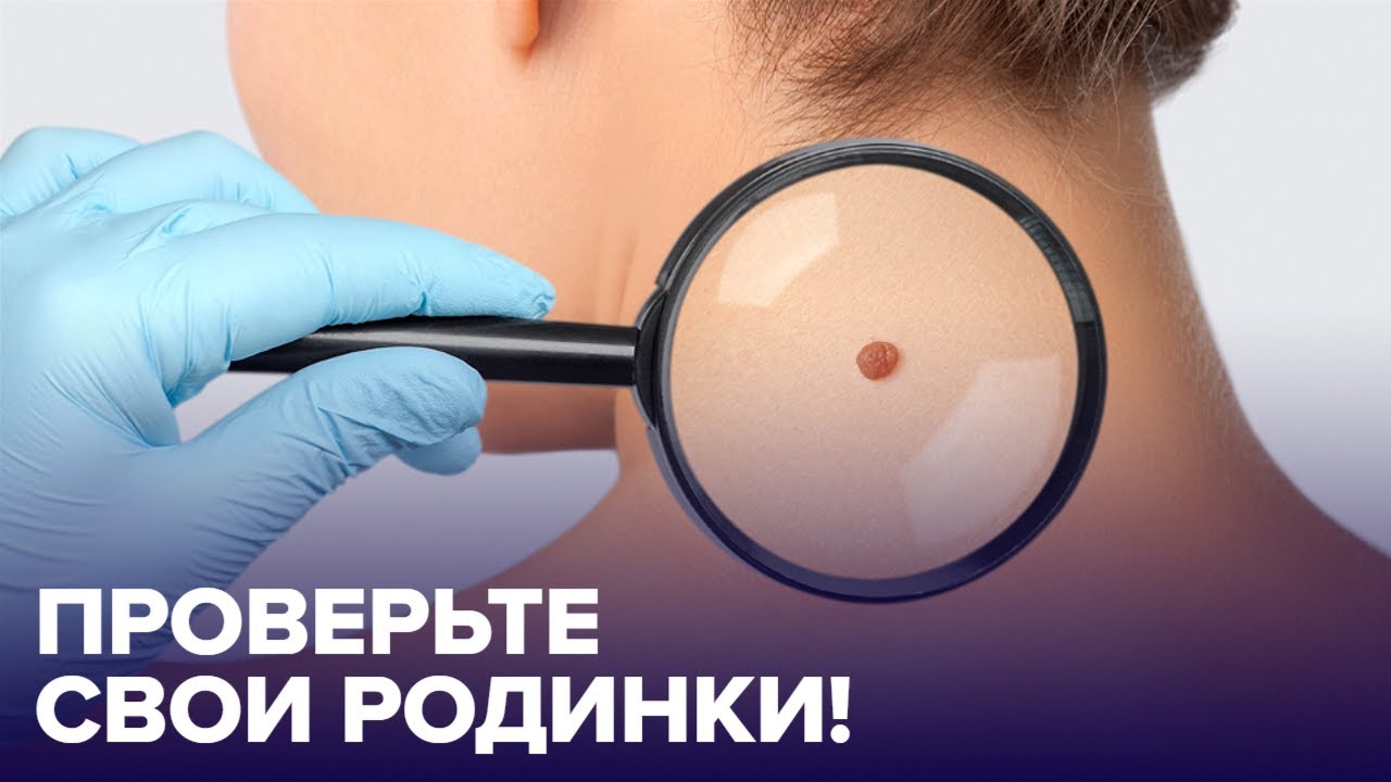 РОДИНКИ на теле: какие из них опасны? смотреть онлайн