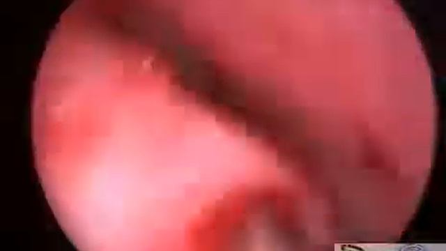 Микрогайморотомия с нижней щадящей конхотомией..mp4 смотреть онлайн