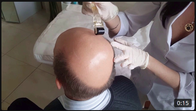 Мезороллер. Применение на голове для роста волос.